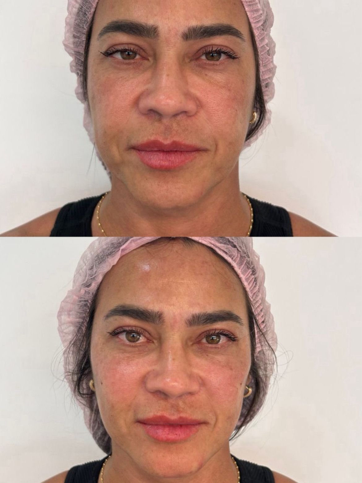 Resultado toxina